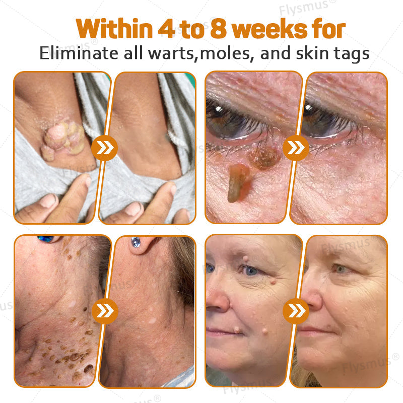 Flysmus® Tag Recede Bee Venom Treatment Cream-LAST DAY 70% OFF-Maximize Skin Renewal