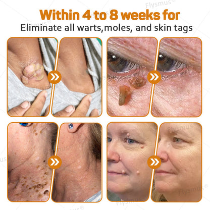 Flysmus® Tag Recede Bee Venom Treatment Cream-LAST DAY 70% OFF-Maximize Skin Renewal