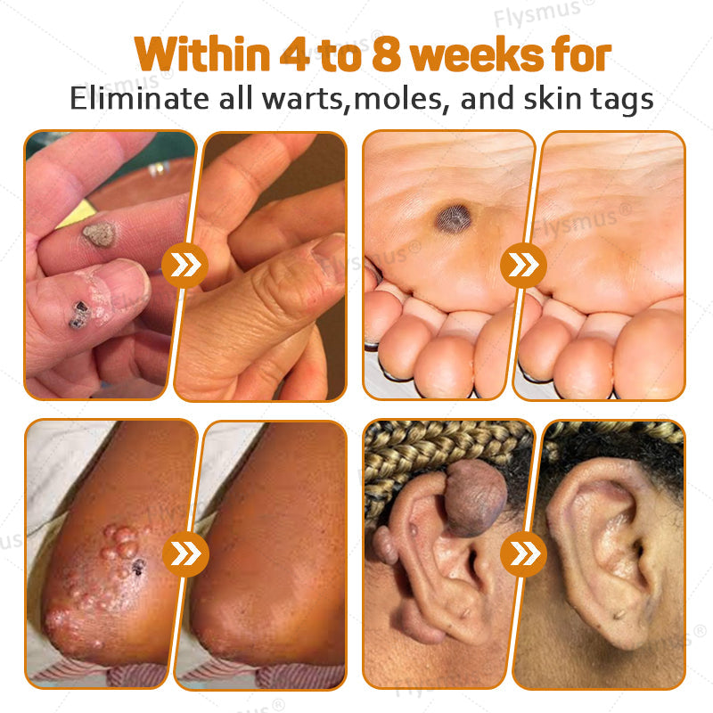 Flysmus® Tag Recede Bee Venom Treatment Cream-LAST DAY 70% OFF-Maximize Skin Renewal