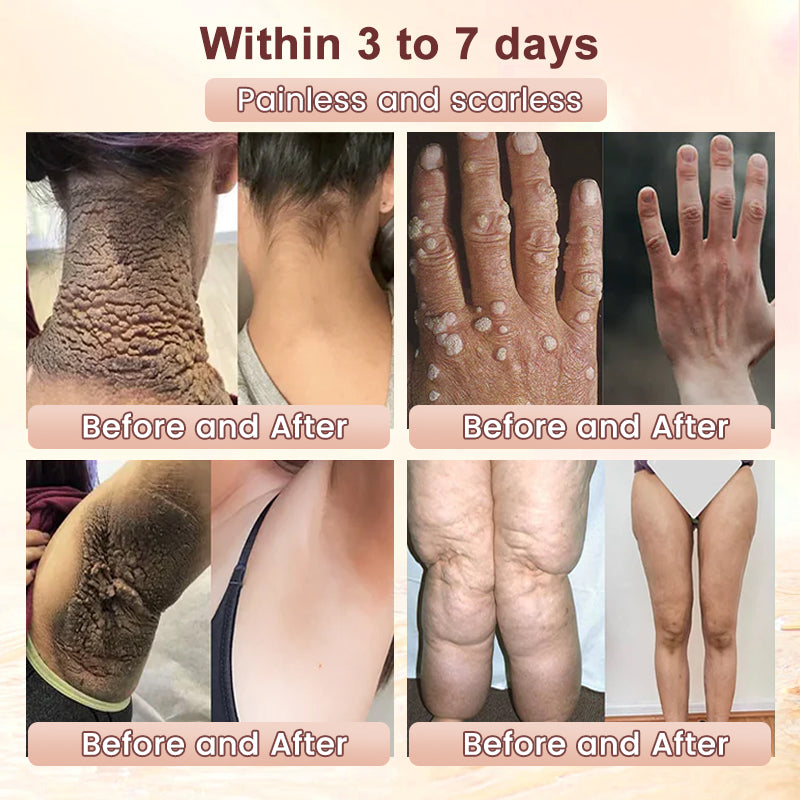 🍀Furzero™️ Quarxery Purifying Enzymes Exfoliating Gel (Also Cure Acanthosis Nigricans)💟