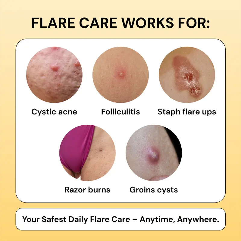 Flysmus®Tea Tree Flare Care| Cystic Acne and Bumps Treatment  Skincare Daily Pimple