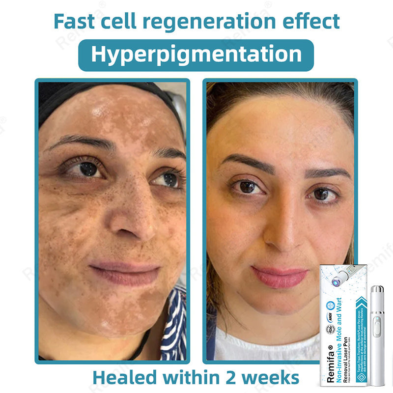 REMIFA® N𝐨n-inv𝐚siv𝐞 𝐌𝐨l𝐞 and W𝐚rt 𝐑𝐞m𝐨v𝐚l L𝐚s𝐞r 𝐏𝐞n 𝐏r𝐨m𝐚x