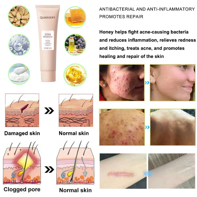 🍀Furzero™️ Quarxery Purifying Enzymes Exfoliating Gel (Also Cure Acanthosis Nigricans)💟