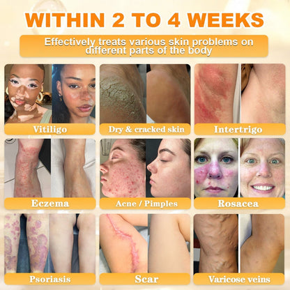 🐝💖FDA Approved|Rolimey® Bee Venom Skin Restoration Cream (Anti-aging, Hydrating, Skin Repair, Even Tone, Acne and Dark Spot Treatment, Wart and Mole Removal, Psoriasis Relief)