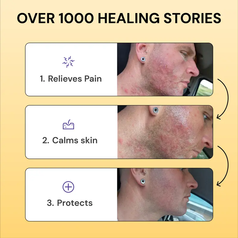 Flysmus®Tea Tree Flare Care| Cystic Acne and Bumps Treatment  Skincare Daily Pimple