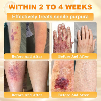 🐝💖FDA Approved|Rolimey® Bee Venom Skin Restoration Cream (Anti-aging, Hydrating, Skin Repair, Even Tone, Acne and Dark Spot Treatment, Wart and Mole Removal, Psoriasis Relief)