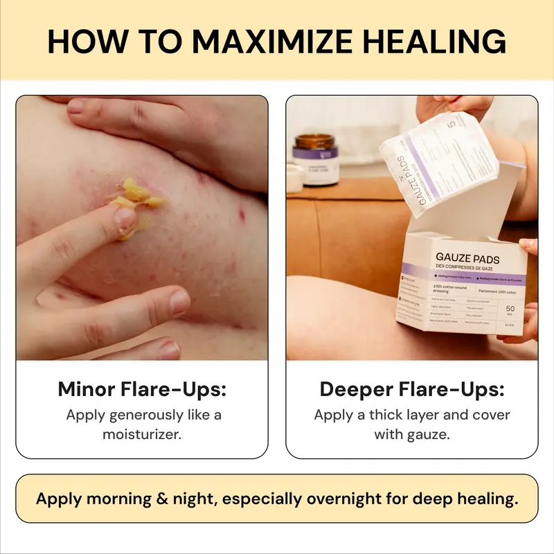 Flysmus®Tea Tree Flare Care| Cystic Acne and Bumps Treatment  Skincare Daily Pimple