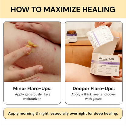 Flysmus®Tea Tree Flare Care| Cystic Acne and Bumps Treatment  Skincare Daily Pimple