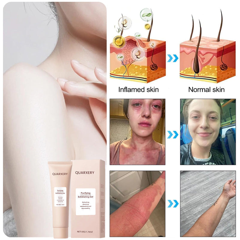 🍀Furzero™️ Quarxery Purifying Enzymes Exfoliating Gel (Also Cure Acanthosis Nigricans)💟