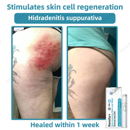 REMIFA® N𝐨n-inv𝐚siv𝐞 𝐌𝐨l𝐞 and W𝐚rt 𝐑𝐞m𝐨v𝐚l L𝐚s𝐞r 𝐏𝐞n 𝐏r𝐨m𝐚x