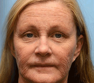 Rolimey® Botox & Vita-A Retinol Shot Wrinkle-Lift Tightening cream - Last Day Promotion 70% OFF