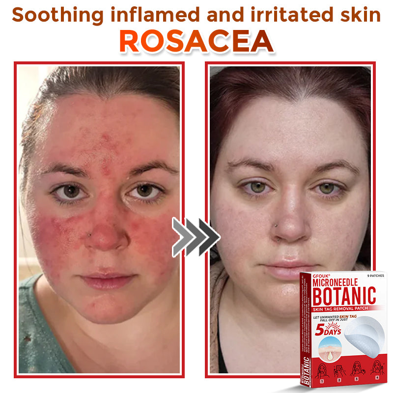 🔥🌻GFOUK® MicroNeedle Botanic Skin Tag Removal Patch 🇺🇸 Made in the USA