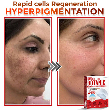 🔥🌻GFOUK® MicroNeedle Botanic Skin Tag Removal Patch 🇺🇸 Made in the USA