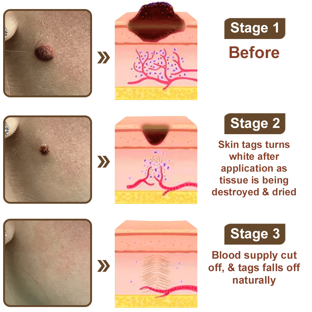 Celsiora® Black Rice Skin Repair Essence Cream ⚕️ FDA Certified (Removes warts and skin growths, improves keratin buildup and seborrheic dermatitis, follicular keratosis, age spots, and bruising) upsell - cikryna