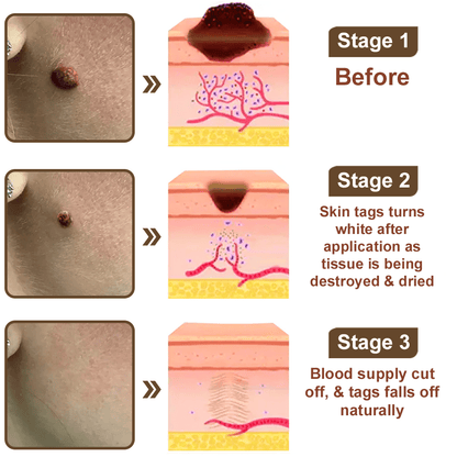 Celsiora® Black Rice Skin Repair Essence Cream ⚕️ FDA Certified (Removes warts and skin growths, improves keratin buildup and seborrheic dermatitis, follicular keratosis, age spots, and bruising) upsell - cikryna