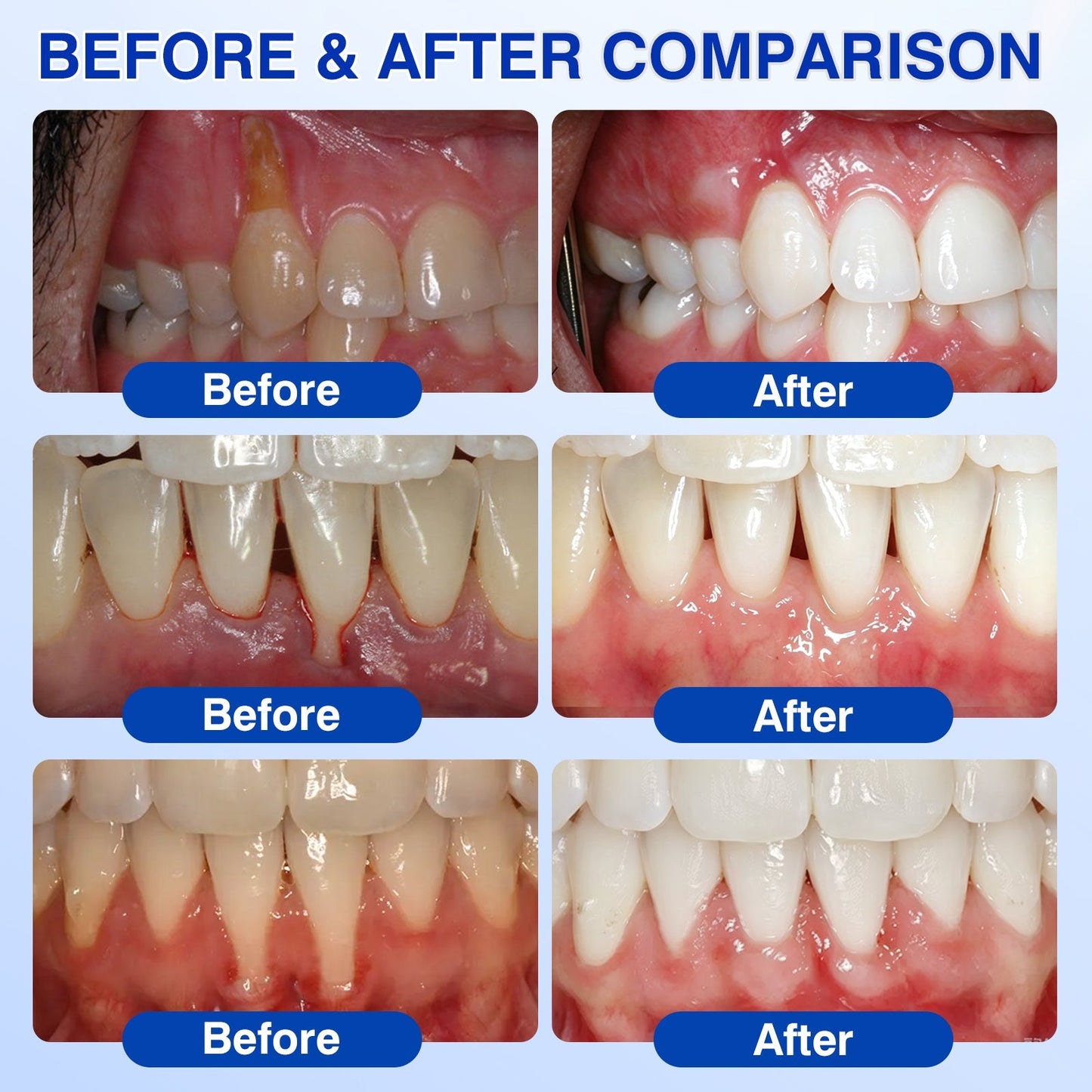 🇺🇸🏆🦷🛡️Evolvion® GumRevive Periodontal Repair Gel upsell - cikryna