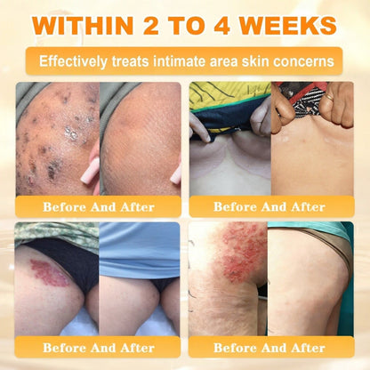 🐝💖FDA Approved|Rolimey® Bee Venom Skin Restoration Cream (Anti - aging, Hydrating, Skin Repair, Even Tone, Acne and Dark Spot Treatment, Wart and Mole Removal, Psoriasis Relief) - cikryna