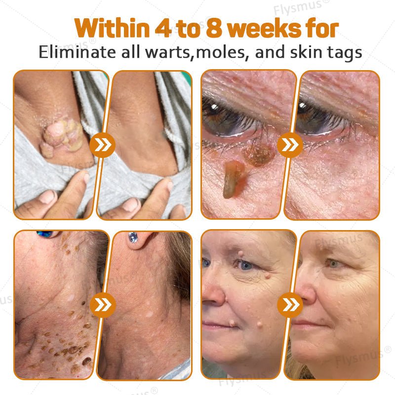 Flysmus® Tag Recede Bee Venom Treatment Cream - LAST DAY 70% OFF - Maximize Skin Renewal - cikryna