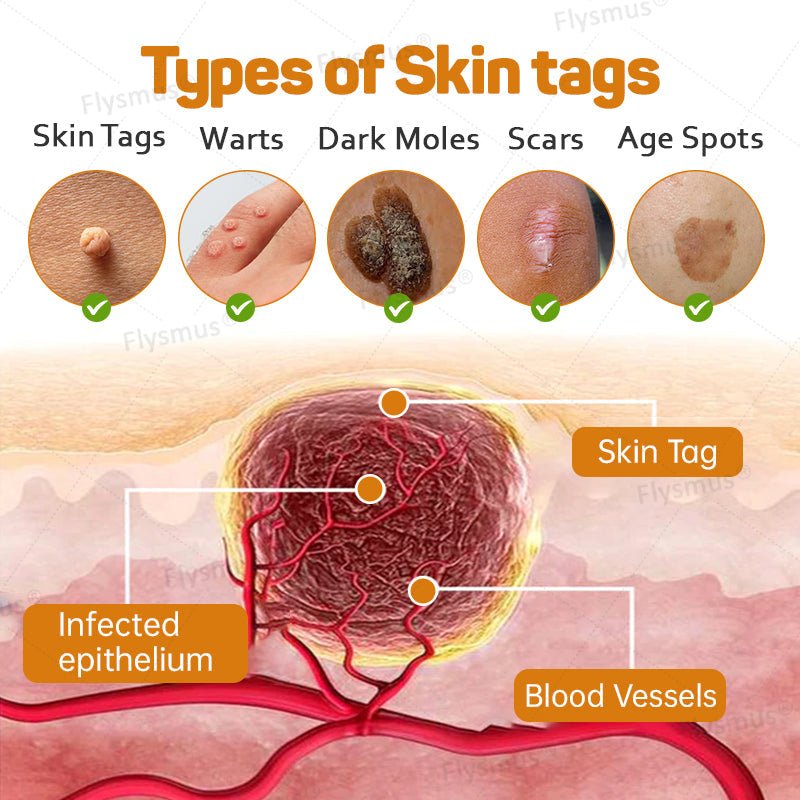 Flysmus® Tag Recede Bee Venom Treatment Cream - LAST DAY 70% OFF - Maximize Skin Renewal - cikryna