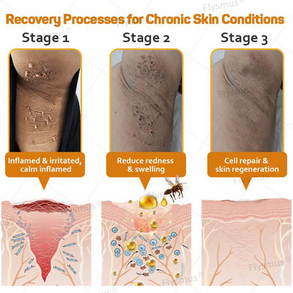 Flysmus® Tag Recede Bee Venom Treatment Cream - LAST DAY 70% OFF - Maximize Skin Renewal - cikryna