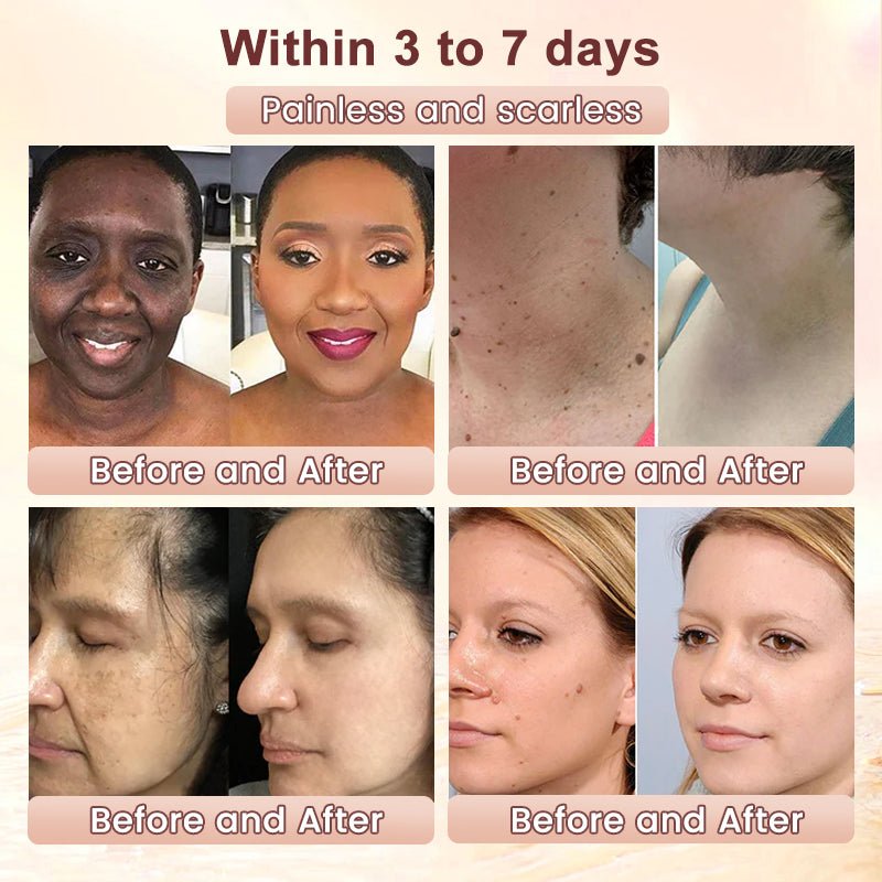 🍀Furzero™️ Quarxery Purifying Enzymes Exfoliating Gel (Also Cure Acanthosis Nigricans)💟 - cikryna