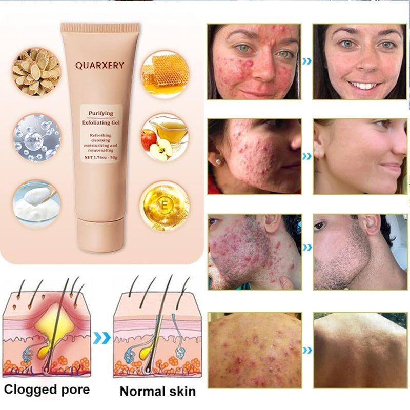 🍀Furzero™️ Quarxery Purifying Enzymes Exfoliating Gel (Also Cure Acanthosis Nigricans)💟 - cikryna