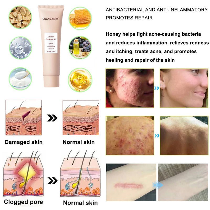 🍀Furzero™️ Quarxery Purifying Enzymes Exfoliating Gel (Also Cure Acanthosis Nigricans)💟 - cikryna