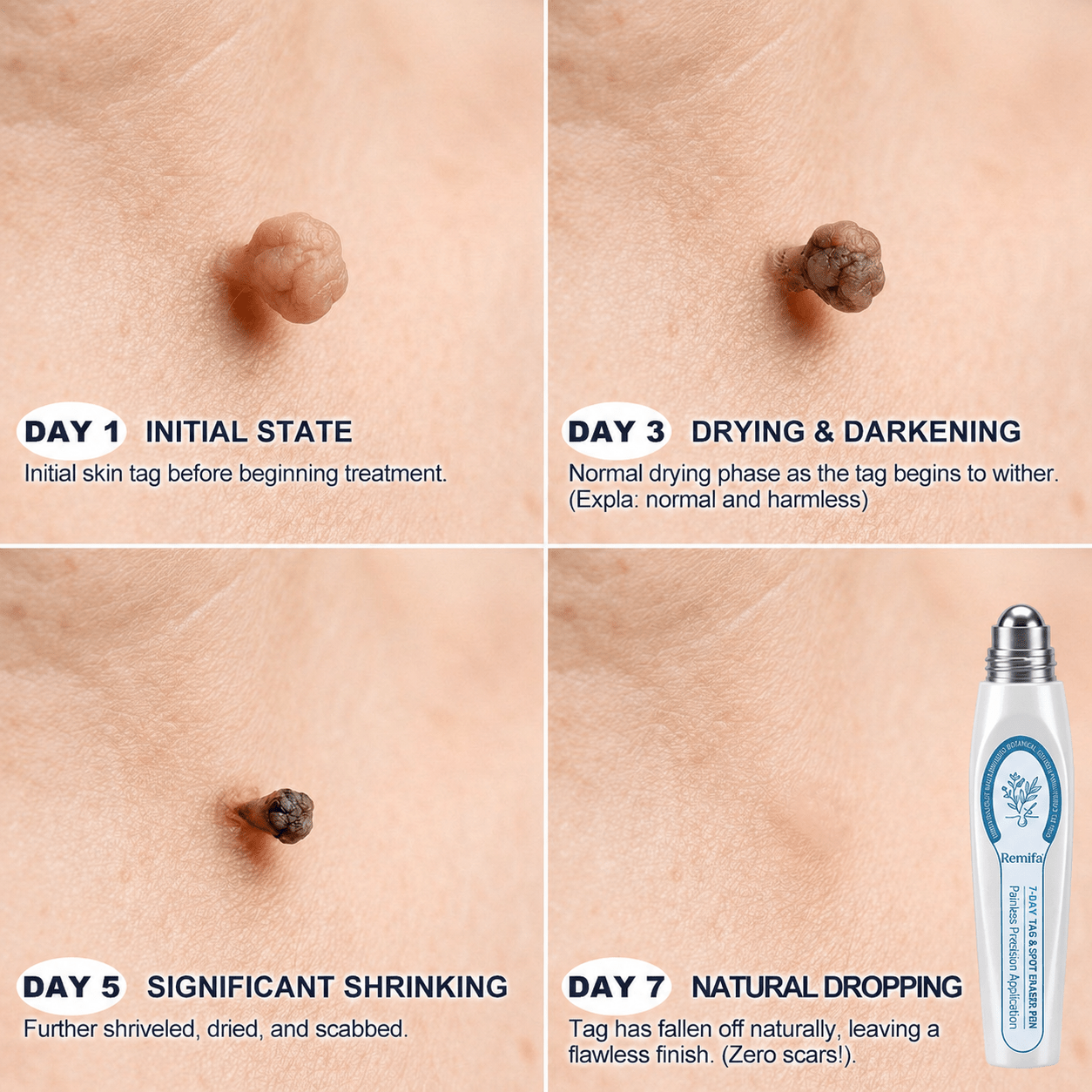 𝐎𝐟𝐟𝐢𝐜𝐢𝐚𝐥 𝐁𝐫𝐚𝐧𝐝 𝐒𝐭𝐨𝐫𝐞 |✅💎Remifa® 7-𝐷𝑎𝑦 𝗧𝐚𝐠 & 𝗦𝗽𝐨𝐭 𝐄𝐫𝒂𝒔𝒆𝒓(Zero Pain, Zero 𝐒𝐜𝐚𝒓𝒔 Rollerball) upsell - cikryna