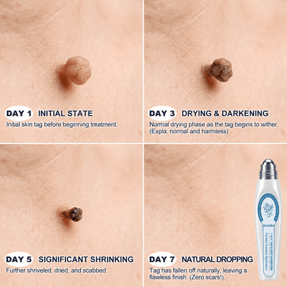 𝐎𝐟𝐟𝐢𝐜𝐢𝐚𝐥 𝐁𝐫𝐚𝐧𝐝 𝐒𝐭𝐨𝐫𝐞 |✅💎Remifa® 7-𝐷𝑎𝑦 𝗧𝐚𝐠 & 𝗦𝗽𝐨𝐭 𝐄𝐫𝒂𝒔𝒆𝒓(Zero Pain, Zero 𝐒𝐜𝐚𝒓𝒔 Rollerball) upsell - cikryna