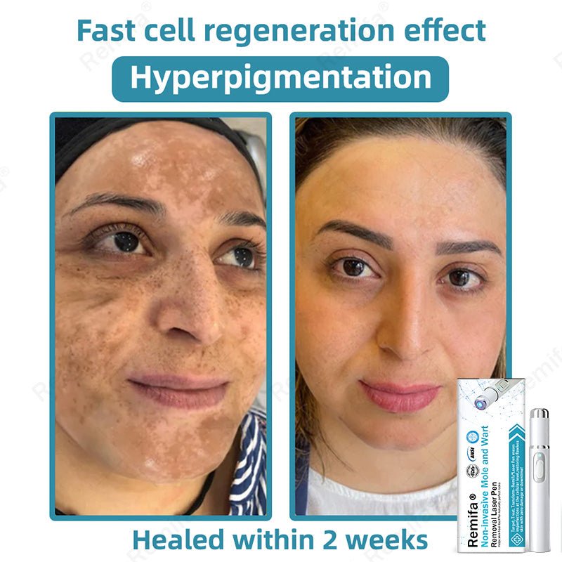 REMIFA® N𝐨n - inv𝐚siv𝐞 𝐌𝐨l𝐞 and W𝐚rt 𝐑𝐞m𝐨v𝐚l L𝐚s𝐞r 𝐏𝐞n 𝐏r𝐨m𝐚x upsell - cikryna