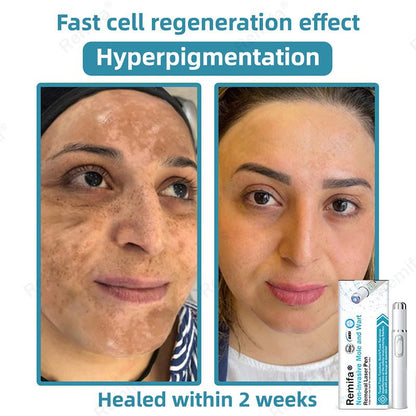 REMIFA® N𝐨n - inv𝐚siv𝐞 𝐌𝐨l𝐞 and W𝐚rt 𝐑𝐞m𝐨v𝐚l L𝐚s𝐞r 𝐏𝐞n 𝐏r𝐨m𝐚x upsell - cikryna